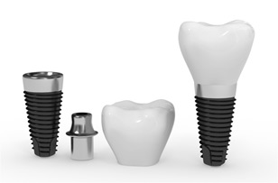 Dental Implant 3D model