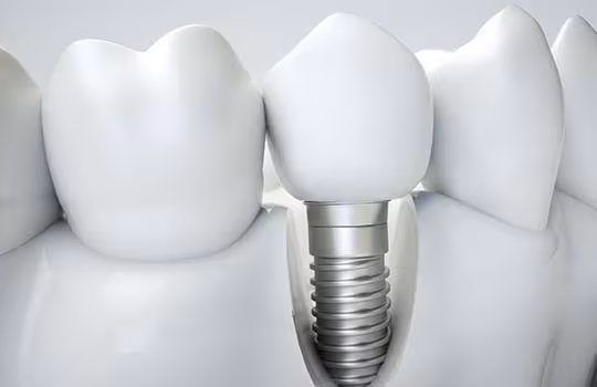 Model of dental implant